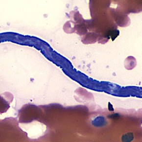 Udaya Ranasinghe, Thishan Channa Yahathugoda: Cheap urine test for lymphatic&nbsp;filariasis